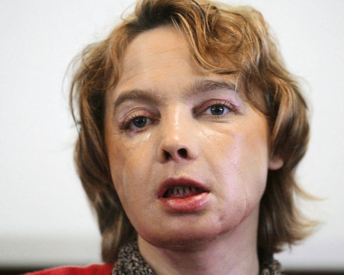 Transplantace obličeje přinesly naději, ale pacienti prožívali nepředstavitelné výzvy.