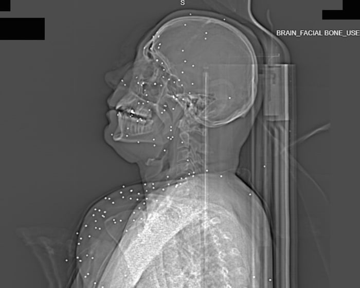 X-rays taken after Iran protests reveal catastrophic injuries, showing deliberate targeting of vital body parts.