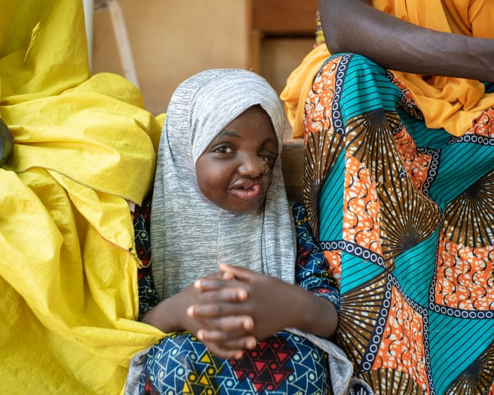 An 'astonishing' discovery could help save children from a deadly, disfiguring condition.